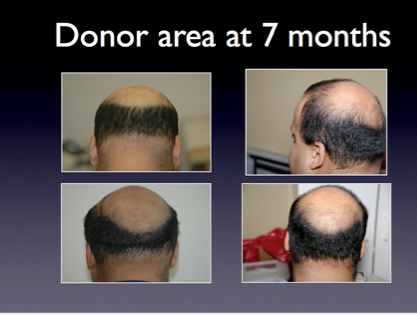 donor harvest 7 mo post